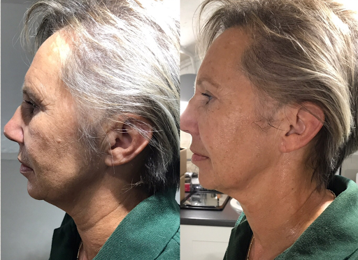 Jan-Val Aesthetics NON SURGICAL FACELIFT & TUMMY TUCK EXPERTS Based In Ballyclare - Thumbnail