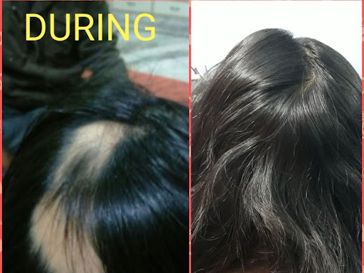 Alopecia Areata- A disease condition with a cosmetic and social concern. The bald patches beautif… post image