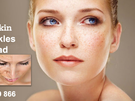 If you are looking for Best #skintags and #frecklesremovalinfaridabad Dr. #AaliyaKhan is one of t… post image
