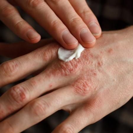 Struggling with eczema, itchy skin, or dry skin patches? Get