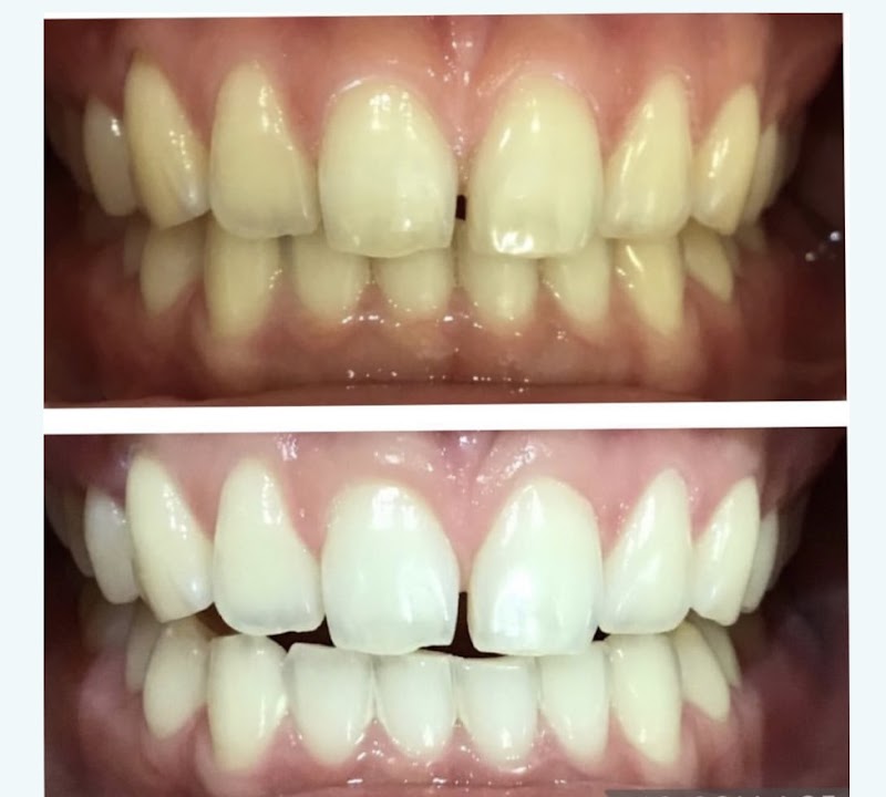 パールホワイトニング大阪梅田院