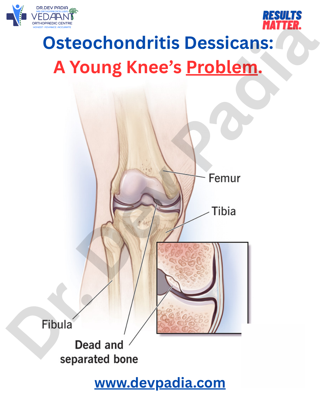 Osteochondritis dissecans (OCD) is a condition that affects your join…