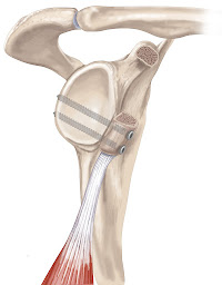 Photo n°17 de Dr Maxime Antoni à Strasbourg (Chirurgien orthopédiste)
