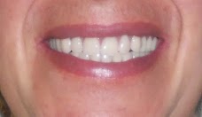 Cosmetic Denture Designers glasgow