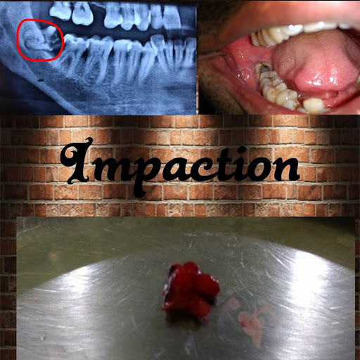 Surgical removal of impacted lower third molar.