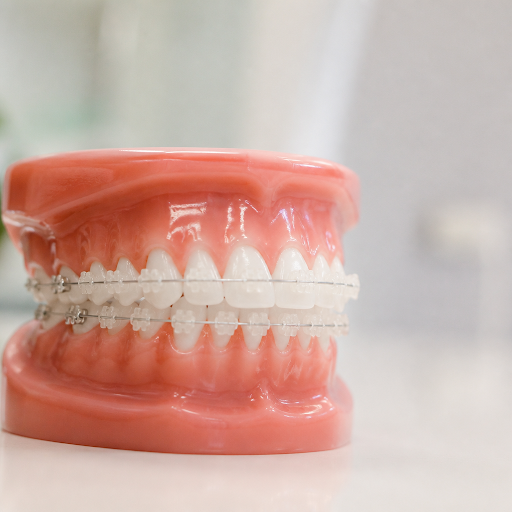 Curious about a more discreet way to straighten your teeth? Ceramic braces are a popular choice f… post image
