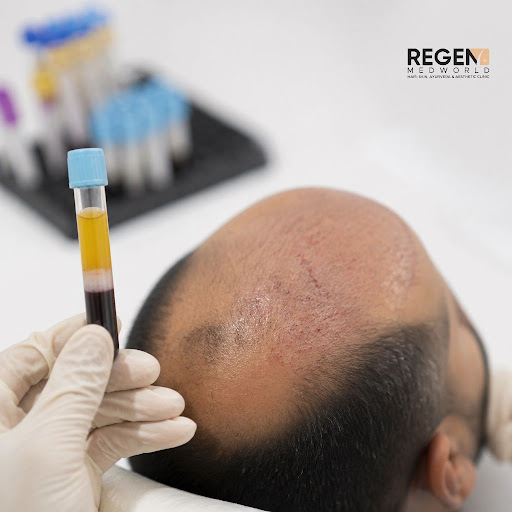 Struggling with hair thinning or bald patches and searching for a dermatologist near me or hair t… post image