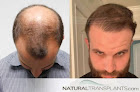 Hair transplant clinic Natural Transplants, Hair Restoration Clinic in Orlando
