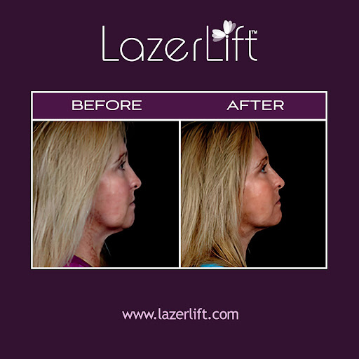 LazerLift - Visual