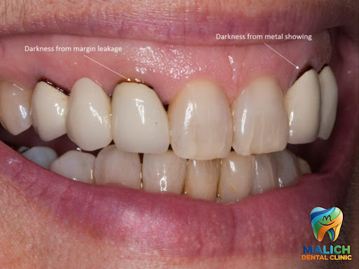 Fix Black Lines and Discolored Edges Around Old Dental Crowns. post image