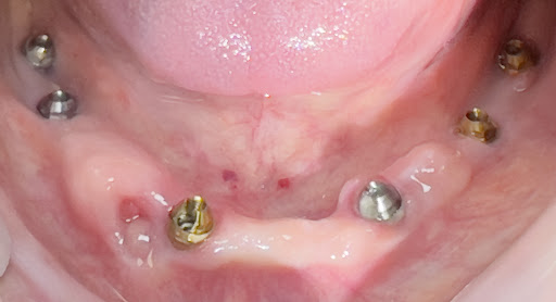 full arch dental implants post image