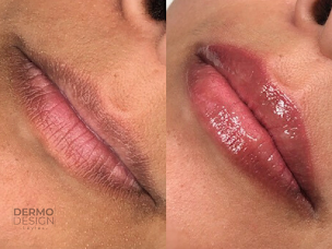 Photo n°12 de DERMODESIGN MERIGNIES à Mérignies (Service de détatouage)