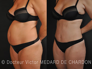 Photo n°10 de Dr. Victor MEDARD DE CHARDON à Cannes (Clinique de chirurgie plastique)