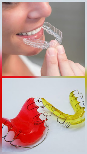 Types of Retainers: Which One Works Best? post image