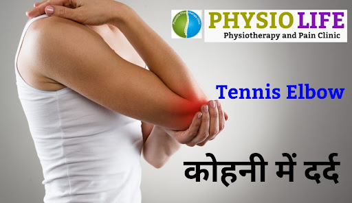 Tennis elbow, also known as lateral epicondylitis, is a condition that can result from overuse of… post image
