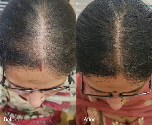🌿 GFC Hair Treatment in Sohna Road Gurgaon – Benefits and Results post image