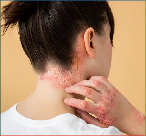 Relief from Psoriasis Starts Here! Get expert diagnosis and 