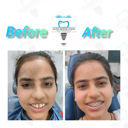 🌟 Braces Treatment Before & After – Gupta Dental Clinic, Loni Ghaziabad 🌟 post image