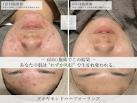 ハーブピーリング専門 La Viora Clinical 明石店 -ハーブピーリング/ニキビ/ニキビ跡/毛穴/シミシワ-