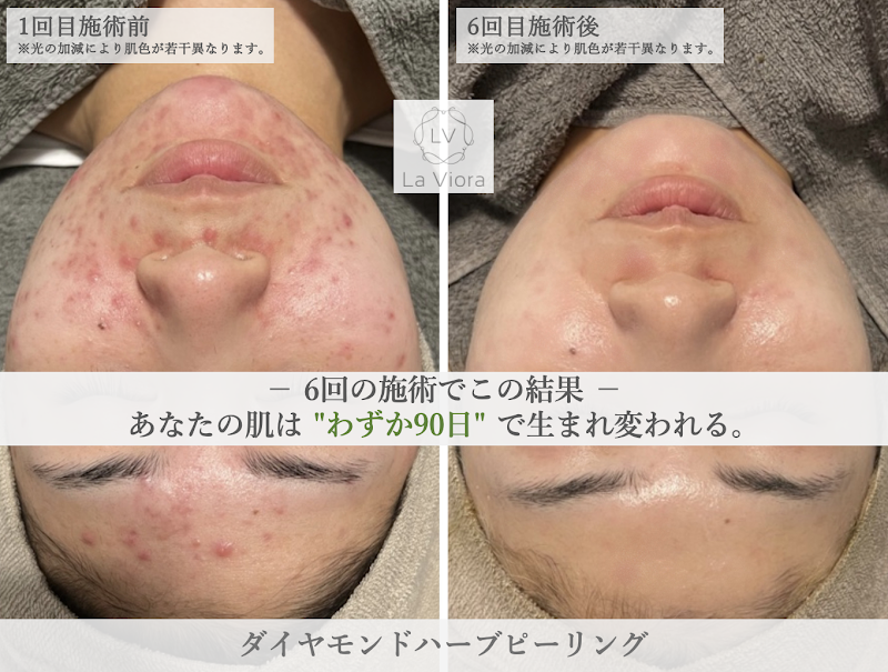 ハーブピーリング専門 La Viora Clinical 明石店 -ハーブピーリング/ニキビ/ニキビ跡/毛穴/シミシワ-