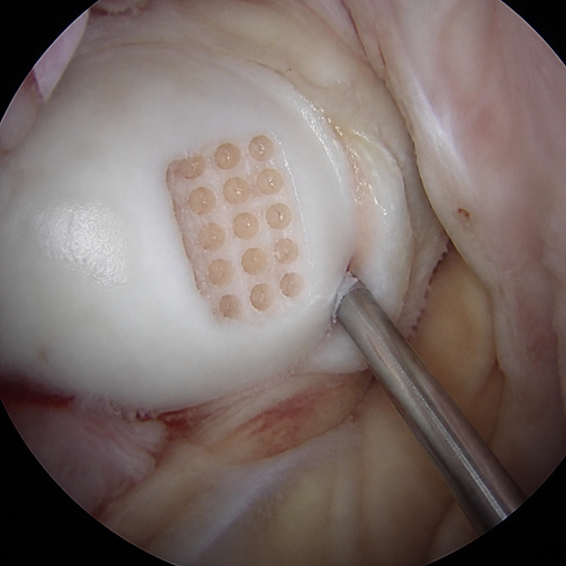 Mosaicplasty is a modern, joint-preserving procedure that helps restore damaged cartilage and red… post image