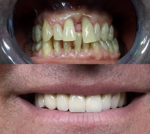 Dott. Antonio Luongo, Dentista Implantologia Salerno - Thumbnail