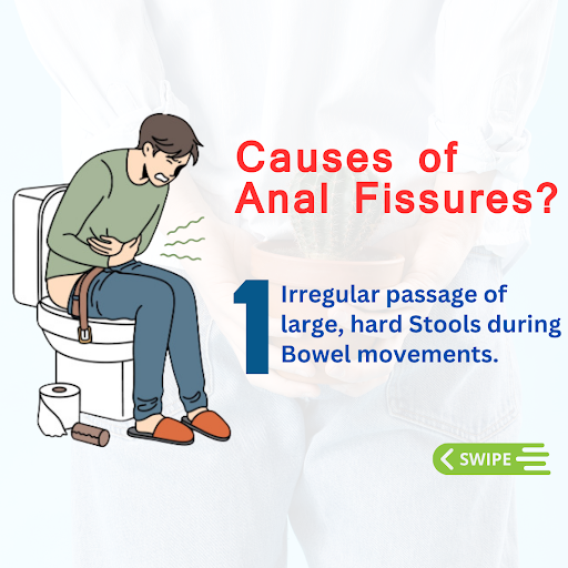 Understanding the causes of irregular passage of large, hard stools during bowel movements is ess…