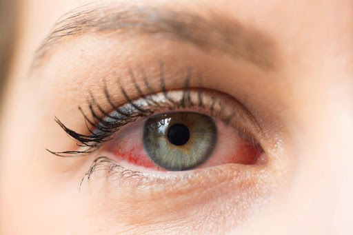 Dry eyes can be a frustrating condition, leading to discomfort, irritation, and blurred vision. T… post image