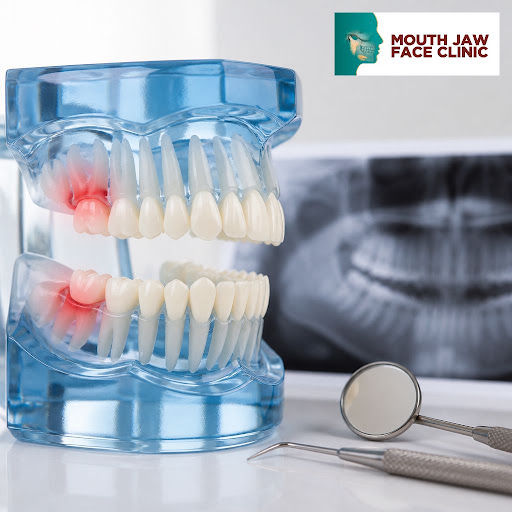 Wondering why your wisdom teeth are causing pain or swelling? At Dr Karan Mehtas Mouth Jaw Face a… post image