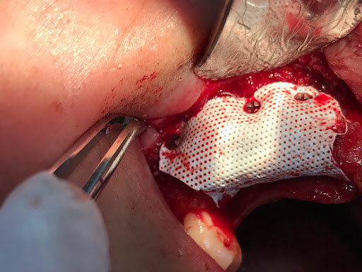 Implantes Dentales en Monterrey Dr Xavier Madrigal - Thumbnail