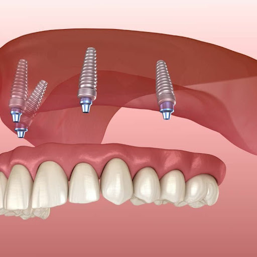 Studio Dentistico Gerevini - Thumbnail