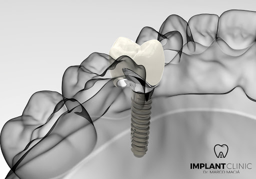 Dr. Marco Maciá Implant Clínic Benijofar - Thumbnail