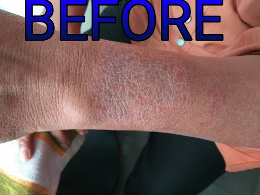 before treatment
