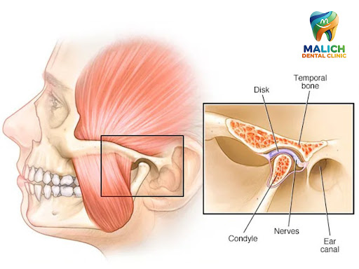 Comprehensive Relief for TMJ Jaw Pain & Clicking. post image