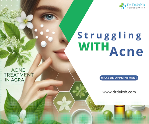 📢 Struggling with Acne in Agra? We Can Help! post image