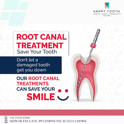 Signs of Root Canal:-