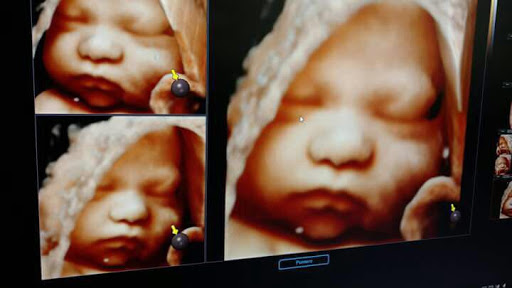 SonoAdvance - Thumbnail