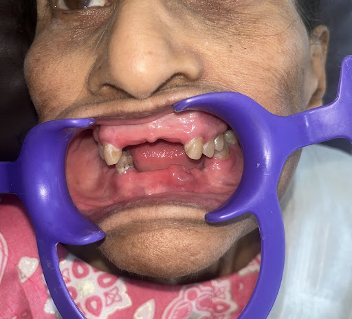 At DENTAMEDICS, we proudly began treatment for a 72-year-old senior citizen, medically compromise… post image