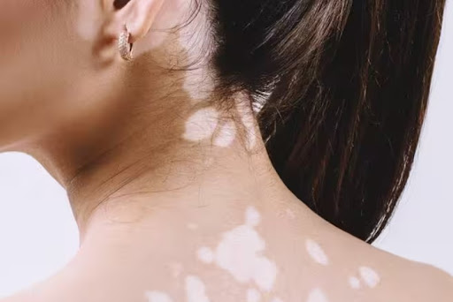 Discover effective treatments for Leucoderma at Dr. Desai's Skin, Hair & Laser Clinic, the premie…