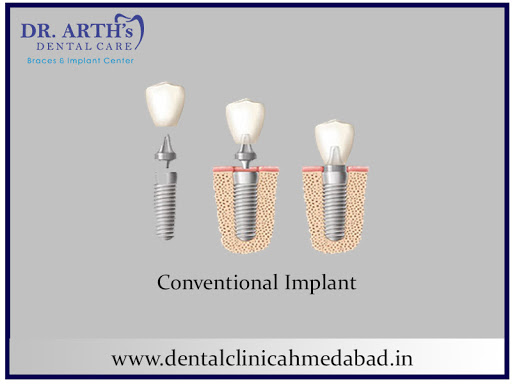 A conventional dental implant is usually known as a “Two Piece” implant which consists of the roo…