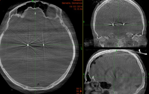 Prof. Domenico Servello, Neurochirurgo