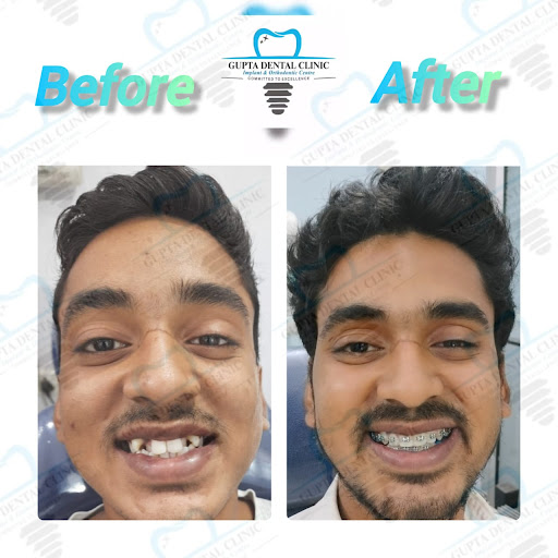 Smile Transformation at Gupta Dental Clinic, Indrapuri, Loni  post image