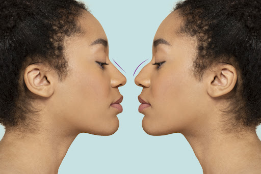 Early evaluation of a Crooked Nose is important, as it helps identify whether the concern is pure… post image