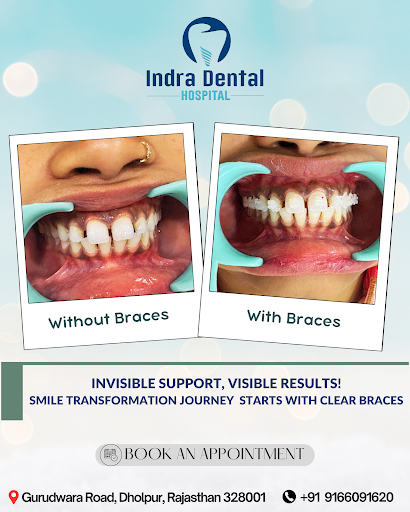 Transform Your Smile with Advanced Orthodontic Solutions! Say goodbye to metal braces and choose… post image