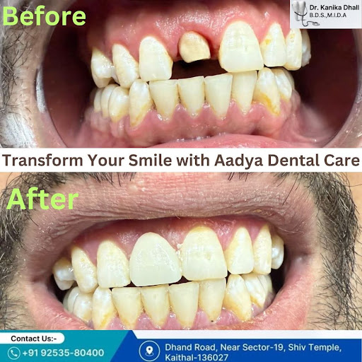 Zirconia crown post image