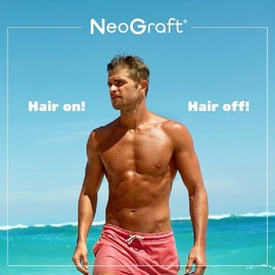 Hair Transplant in Newport Beach