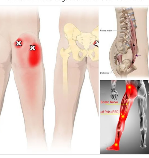 Sciatica, slip disc,backpain, joint pain,leg pain are treated by Ayurved Panchkarma Acupuncture t… post image