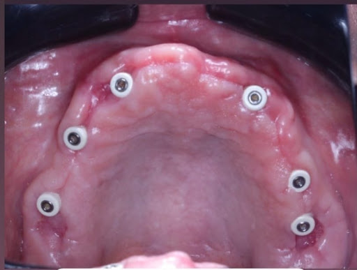 🦷 Restore Your Smile with Advanced Dental Implants at Revive Face Dental Centre! post image