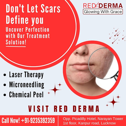 Acne scars, Hollywood facial, hydra facial and face PRP available at RED DERMA CLINIC Lucknow bes… post image