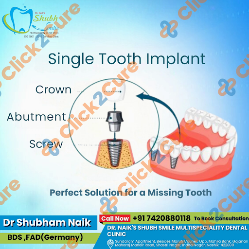 Missing a single tooth? A dental implant might be the perfect solution. Restore your smile and co…